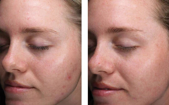 Skinbetter Science Alpharet Clearing Serum