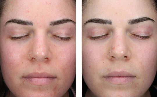 Skinbetter Science Alpharet Clearing Serum