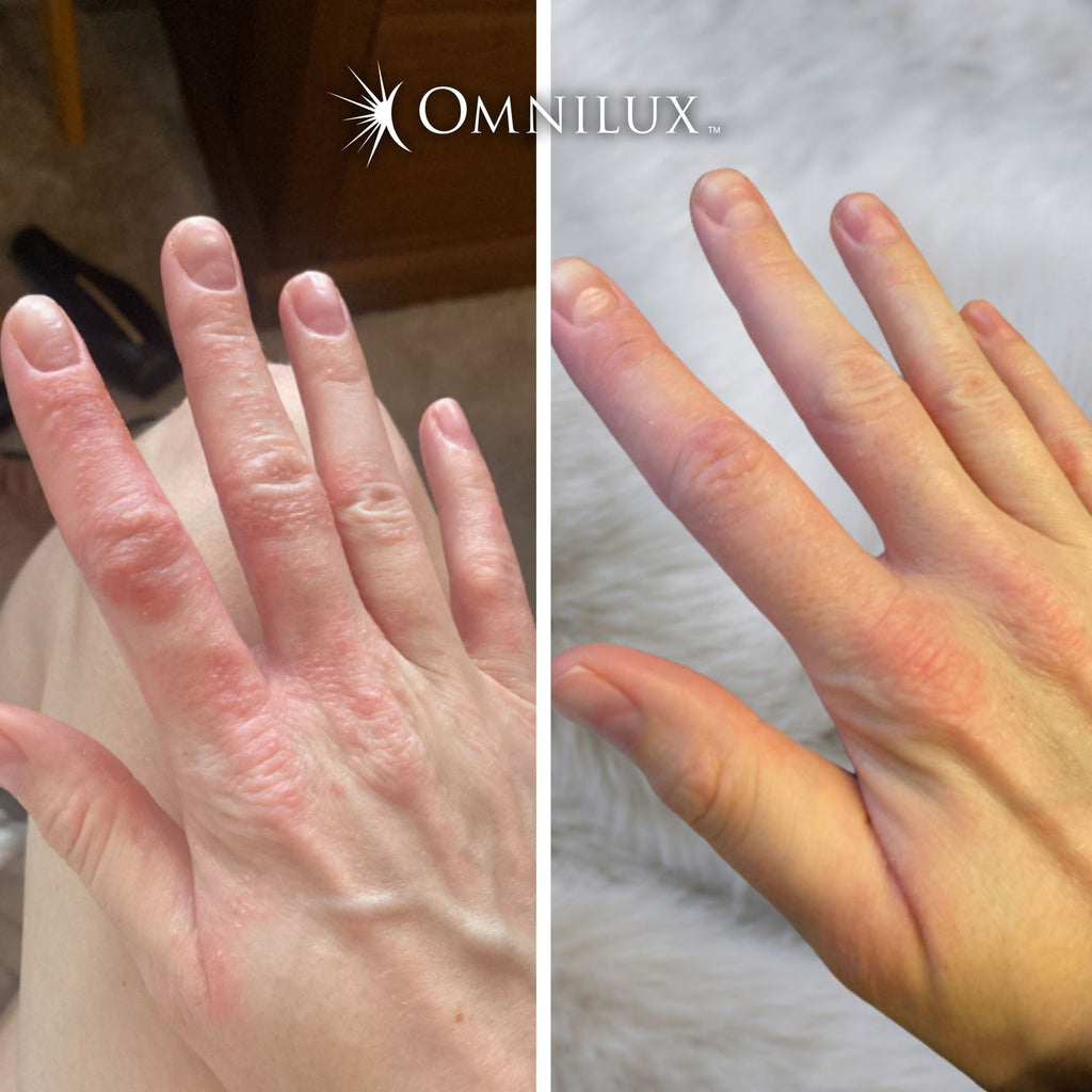 Omnilux Contour™ LED Glove