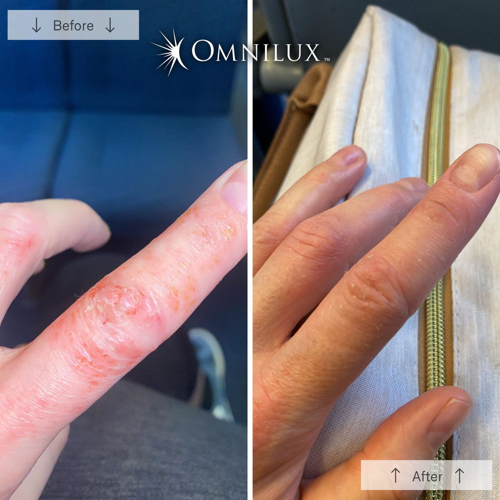 Omnilux Contour™ LED Glove