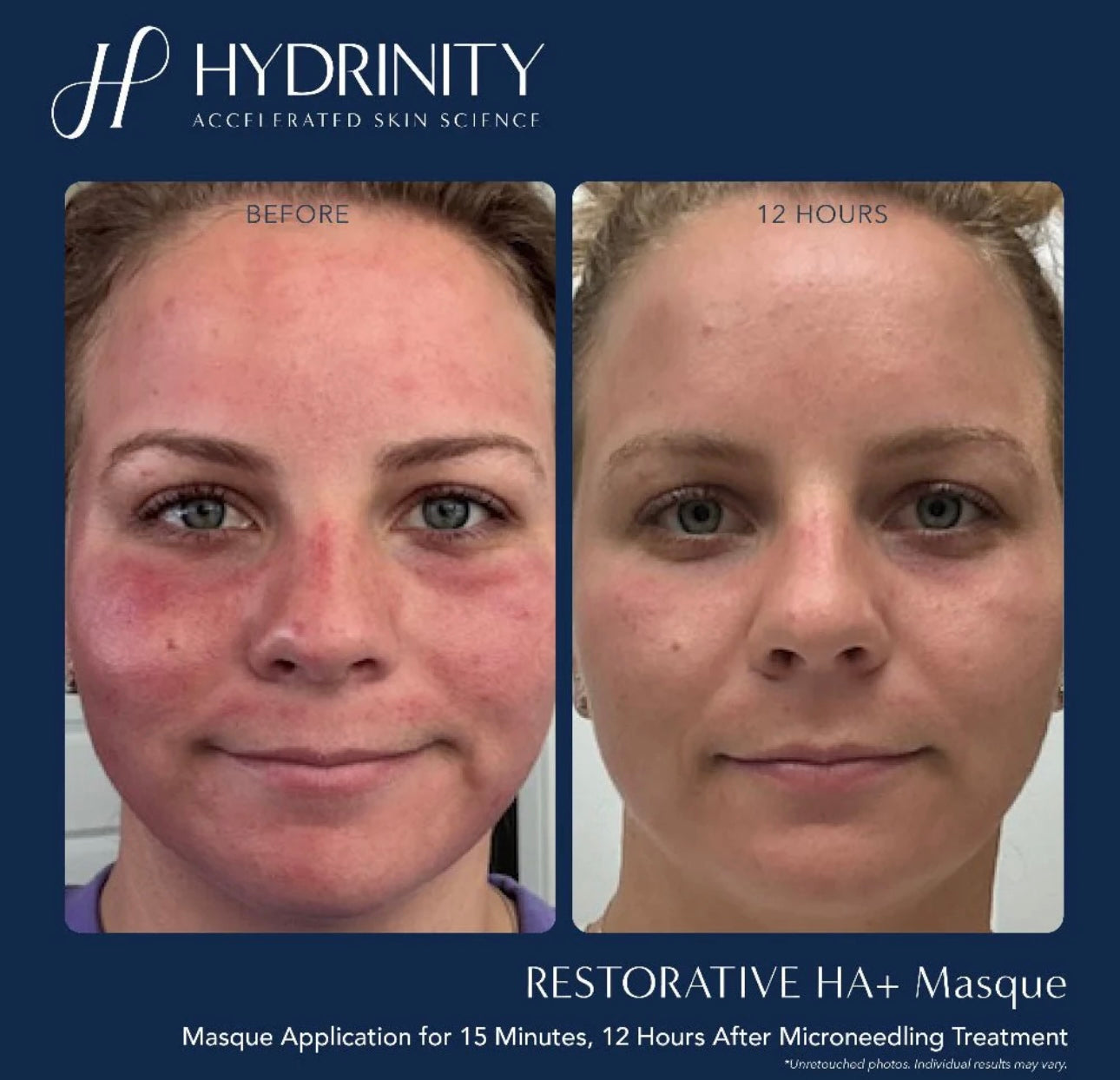 Hydrinity HA+ Masque-Box of 5