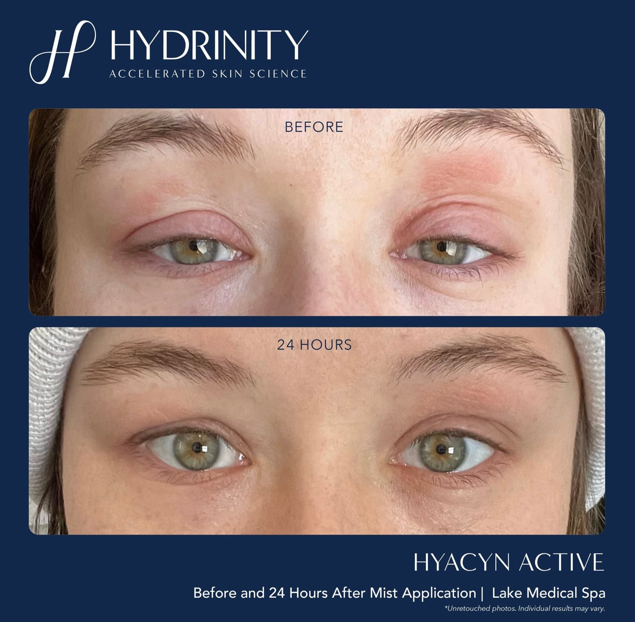Hydrinity Hyacyn Active Spray - LIMTED EDITION (ROSE GOLD)