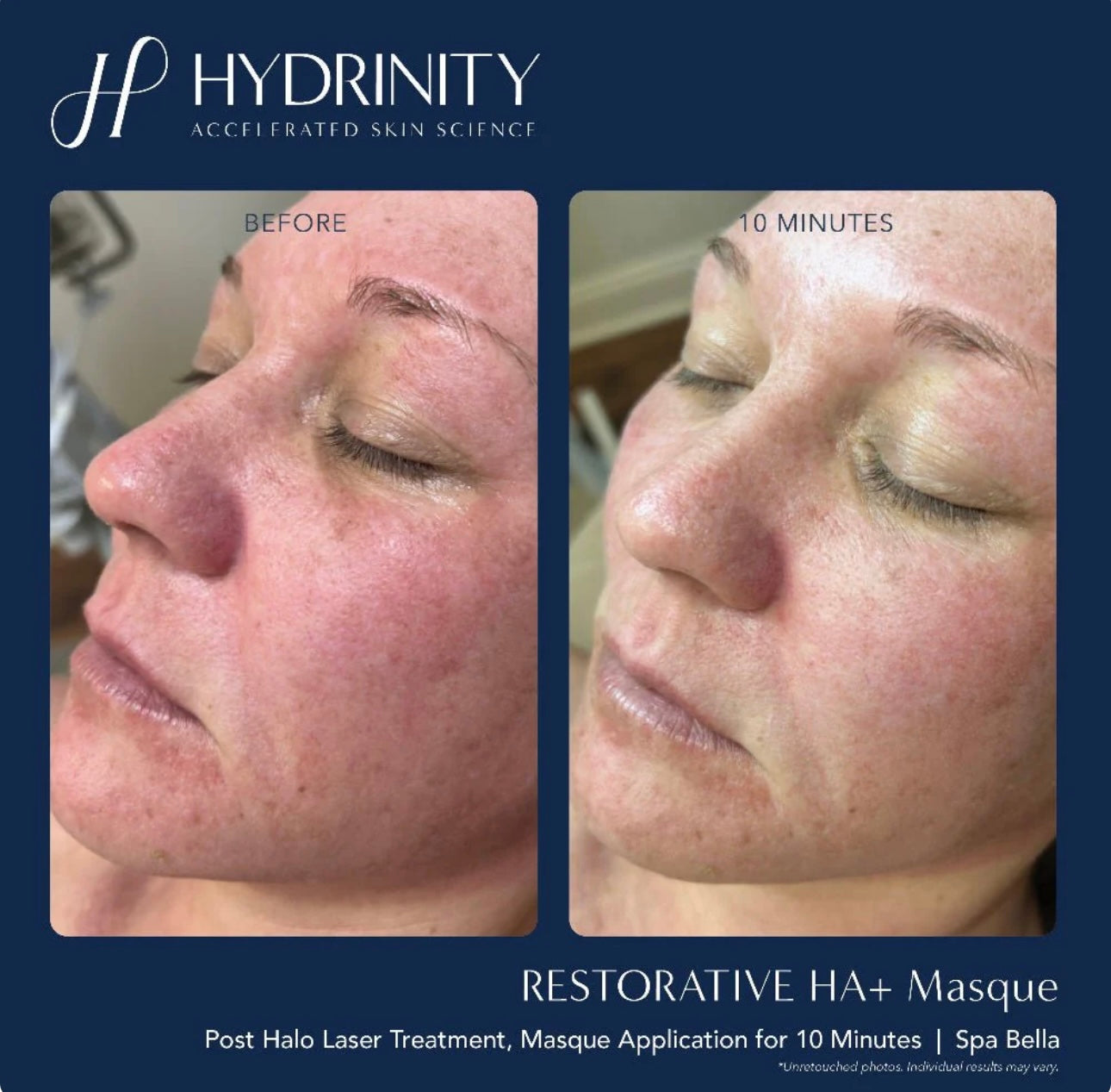 Hydrinity HA+ Masque-Box of 5