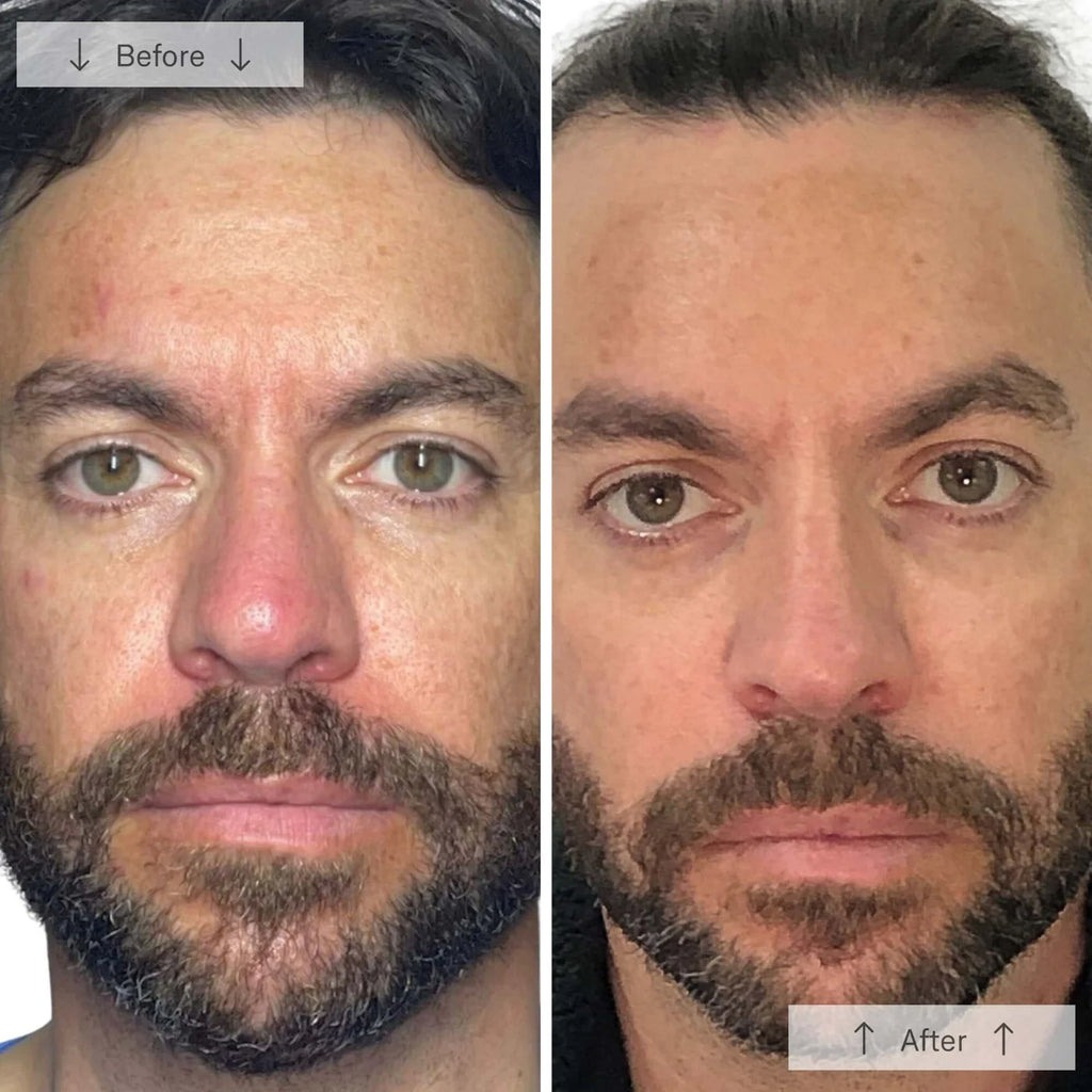 Omnilux Men™ LED Face Mask