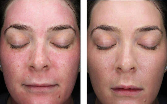Skinbetter Science Sunbetter Tone Smart SPF 75 Tinted Sunscreen